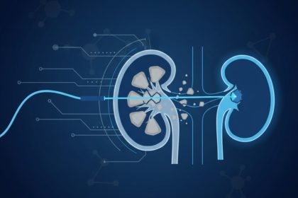 Minimally Invasive Laser Therapies for Kidney Stones